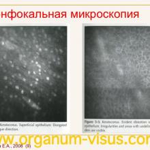 Каспарова Е.А. Современные технологии в диагностике и лечении кератоконуса (Keratoconus). Офтальмологический портал Орган зрения www.organum-visus.com