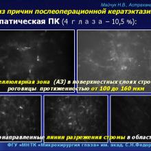 Майчук Н.В. Кератоконус и кераторефракционная хирургия: мифы и реальность. Доклад на Научно-практической конференции офтальмологов Южного федерального округа с участием специалистов Прикаспийских государств "Инновационные технологии в офтальмологической практике регионов" (г. Астрахань, Россия, 10-11 октября 2014г.). Информационный партнер офтальмологический портал Орган зрения www.organum-visus.com