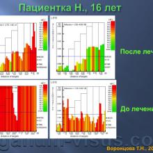 Воронцова Т.Н. Нарушения аккомодации и их лечение (Accommodation disturbances and their treatment). Лекция для офтальмологов, оптиков, оптометристов и специалистов, изучающих орган зрения. Портал www.organum-visus.com